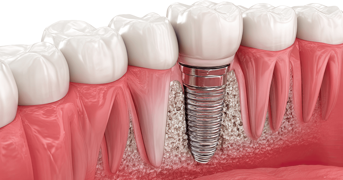 Dental Implants